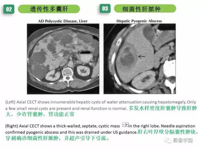 【PPT】疾病谱——肝囊性肿块