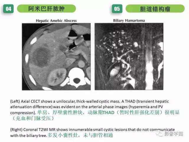 【PPT】疾病谱——肝囊性肿块