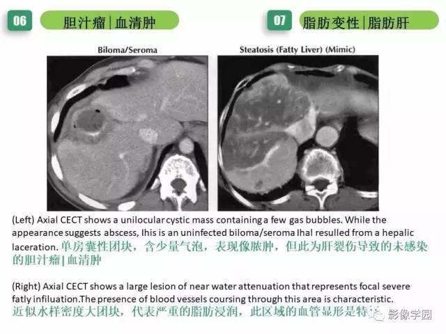 【PPT】疾病谱——肝囊性肿块