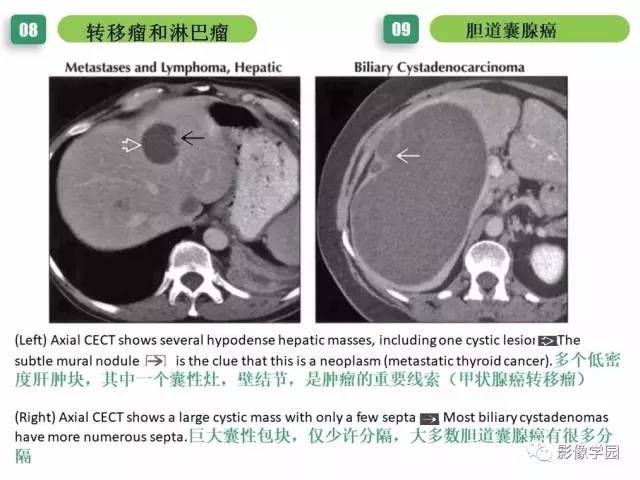 【PPT】疾病谱——肝囊性肿块