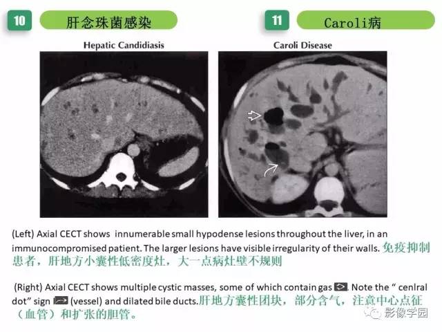 【PPT】疾病谱——肝囊性肿块