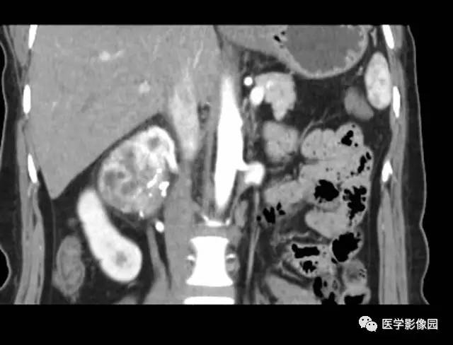 【病例】巨淋巴结增生症1例CT影像表现 【病例】巨淋巴结增生症1例CT影像表现