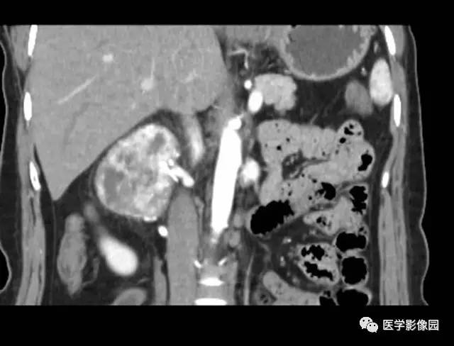 【病例】巨淋巴结增生症1例CT影像表现 【病例】巨淋巴结增生症1例CT影像表现