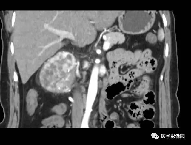 【病例】巨淋巴结增生症1例CT影像表现 【病例】巨淋巴结增生症1例CT影像表现