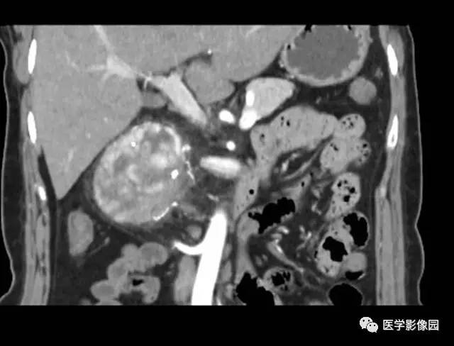 【病例】巨淋巴结增生症1例CT影像表现 【病例】巨淋巴结增生症1例CT影像表现