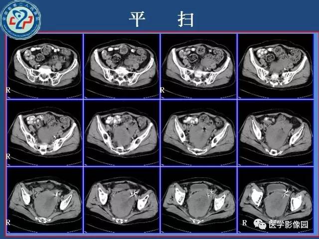 【病例】卵巢浆液性囊腺癌侵犯直肠1例CT