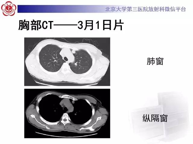 【病例】肉芽肿性多血管炎(韦格纳肉芽肿)1例CT
