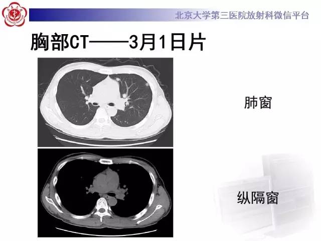 【病例】肉芽肿性多血管炎(韦格纳肉芽肿)1例CT