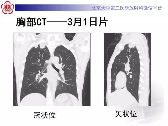 【病例】肉芽肿性多血管炎(韦格纳肉芽肿)1例CT