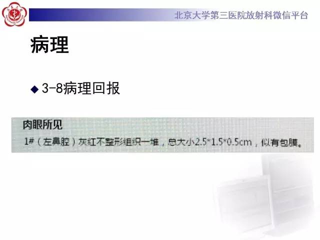 【病例】肉芽肿性多血管炎(韦格纳肉芽肿)1例CT
