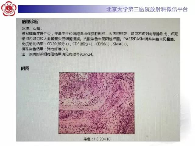 【病例】肉芽肿性多血管炎(韦格纳肉芽肿)1例CT