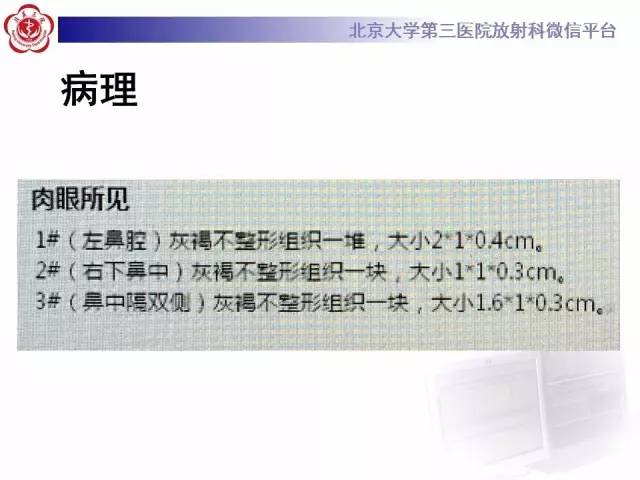【病例】肉芽肿性多血管炎(韦格纳肉芽肿)1例CT