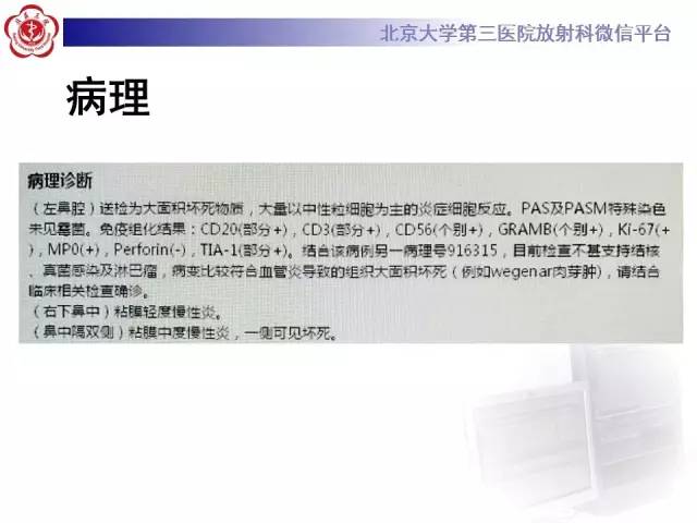 【病例】肉芽肿性多血管炎(韦格纳肉芽肿)1例CT