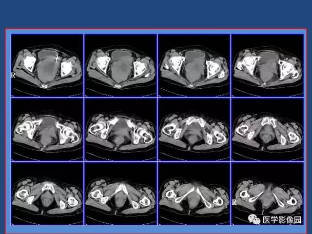 【病例】卵巢浆液性囊腺癌侵犯直肠1例CT 【病例】卵巢浆液性囊腺癌侵犯直肠1例CT