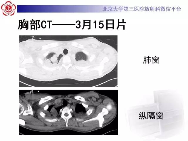 【病例】肉芽肿性多血管炎(韦格纳肉芽肿)1例CT