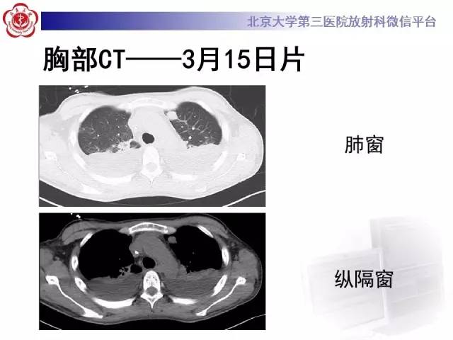 【病例】肉芽肿性多血管炎(韦格纳肉芽肿)1例CT