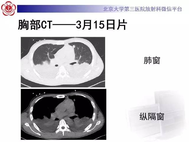 【病例】肉芽肿性多血管炎(韦格纳肉芽肿)1例CT