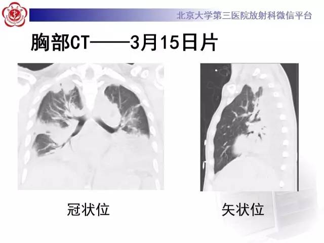 【病例】肉芽肿性多血管炎(韦格纳肉芽肿)1例CT