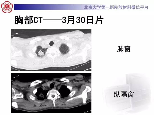 【病例】肉芽肿性多血管炎(韦格纳肉芽肿)1例CT