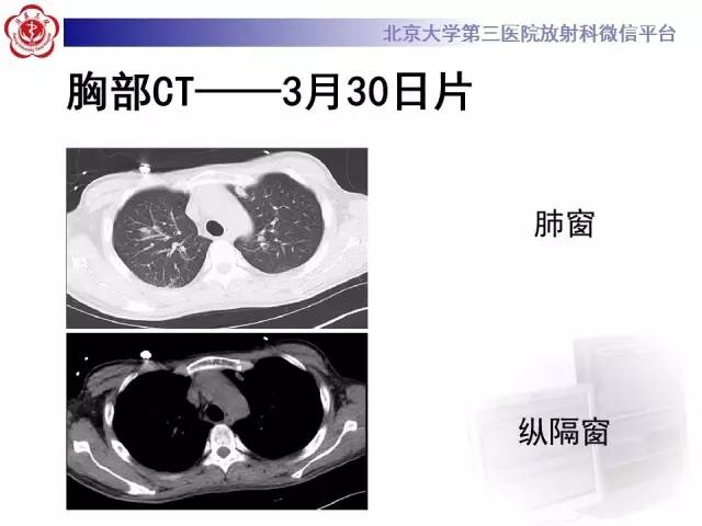 【病例】肉芽肿性多血管炎(韦格纳肉芽肿)1例CT