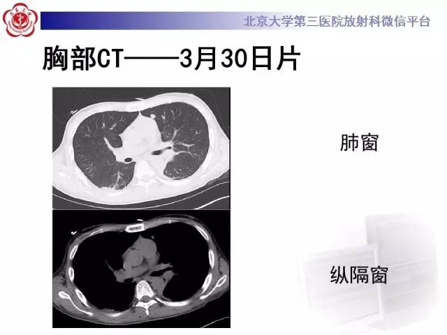 【病例】肉芽肿性多血管炎(韦格纳肉芽肿)1例CT