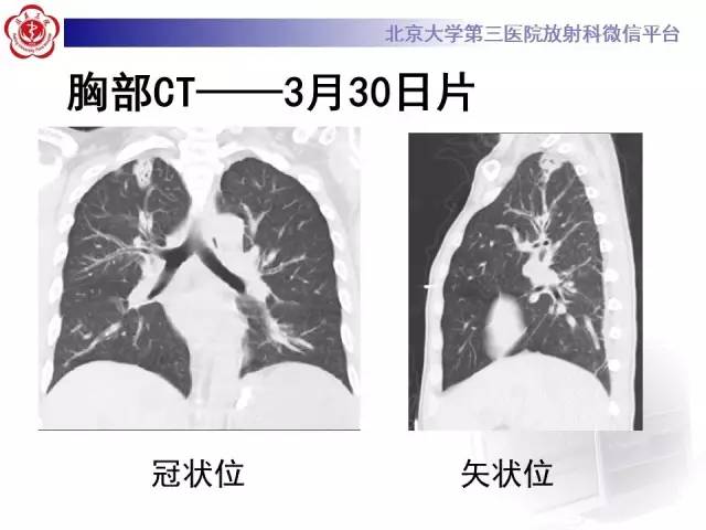 【病例】肉芽肿性多血管炎(韦格纳肉芽肿)1例CT