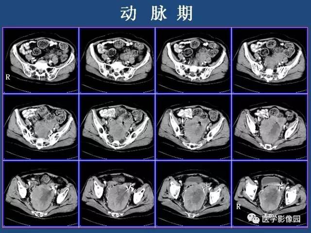 【病例】卵巢浆液性囊腺癌侵犯直肠1例CT 【病例】卵巢浆液性囊腺癌侵犯直肠1例CT