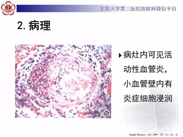 【病例】肉芽肿性多血管炎(韦格纳肉芽肿)1例CT