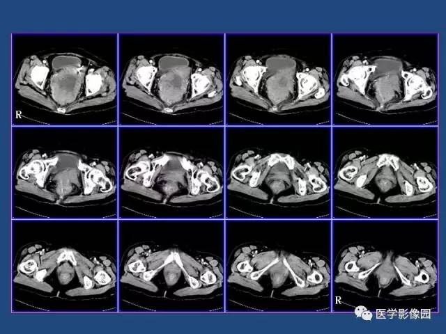【病例】卵巢浆液性囊腺癌侵犯直肠1例CT 【病例】卵巢浆液性囊腺癌侵犯直肠1例CT
