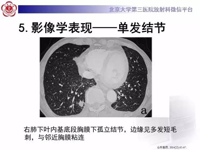 【病例】肉芽肿性多血管炎(韦格纳肉芽肿)1例CT