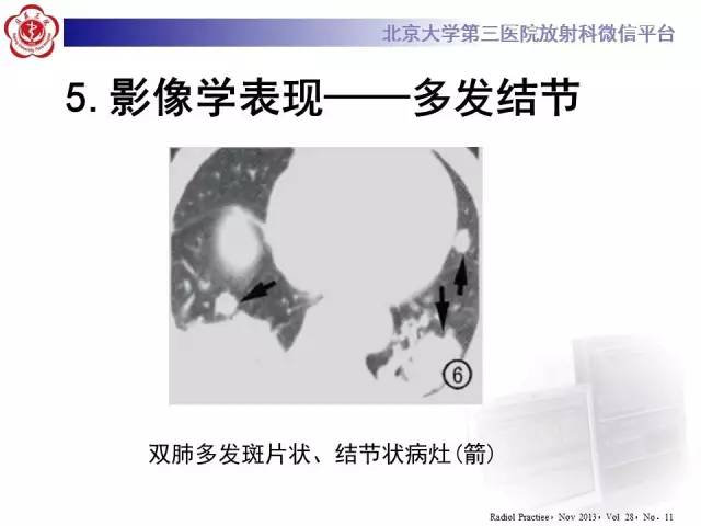 【病例】肉芽肿性多血管炎(韦格纳肉芽肿)1例CT