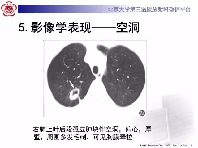 【病例】肉芽肿性多血管炎(韦格纳肉芽肿)1例CT