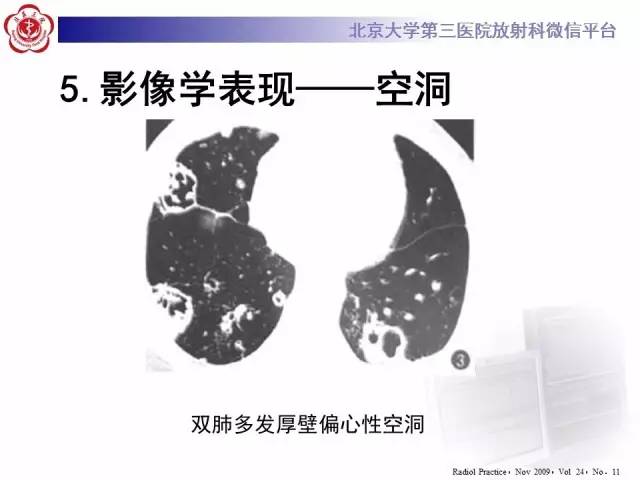 【病例】肉芽肿性多血管炎(韦格纳肉芽肿)1例CT