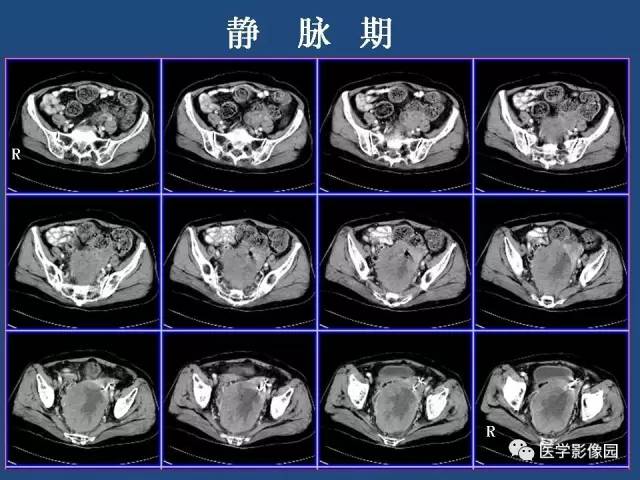 【病例】卵巢浆液性囊腺癌侵犯直肠1例CT 【病例】卵巢浆液性囊腺癌侵犯直肠1例CT