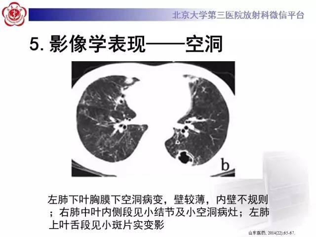 【病例】肉芽肿性多血管炎(韦格纳肉芽肿)1例CT