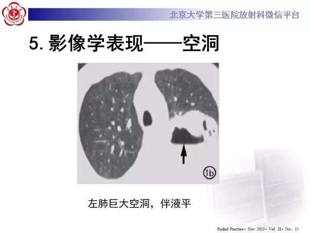 【病例】肉芽肿性多血管炎(韦格纳肉芽肿)1例CT