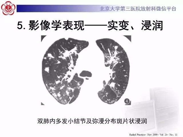 【病例】肉芽肿性多血管炎(韦格纳肉芽肿)1例CT