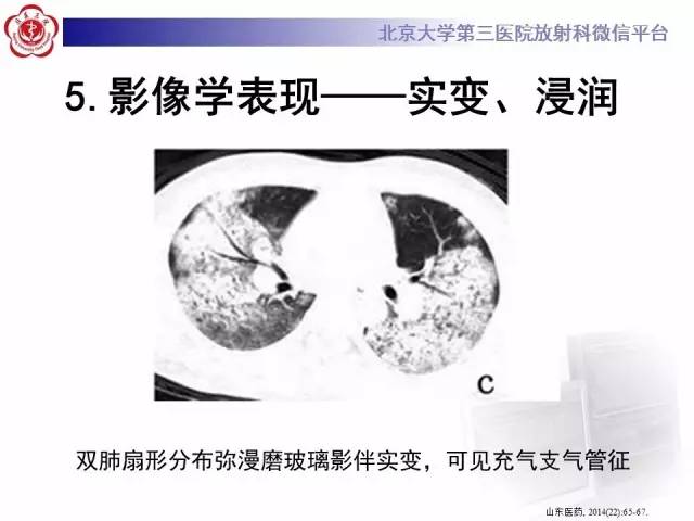 【病例】肉芽肿性多血管炎(韦格纳肉芽肿)1例CT