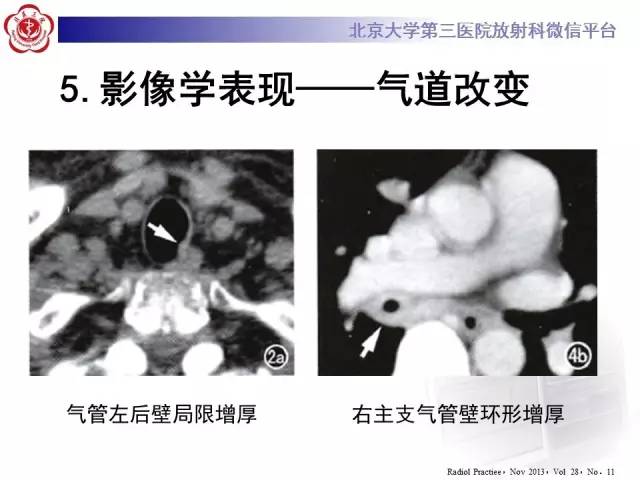 【病例】肉芽肿性多血管炎(韦格纳肉芽肿)1例CT