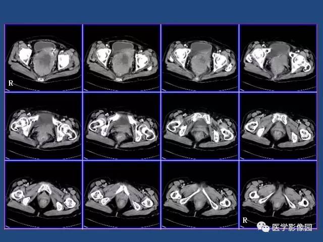 【病例】卵巢浆液性囊腺癌侵犯直肠1例CT 【病例】卵巢浆液性囊腺癌侵犯直肠1例CT