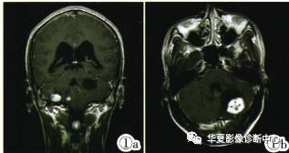 【病例】VHL综合征1例CT及MR 【病例】VHL综合征1例CT及MR