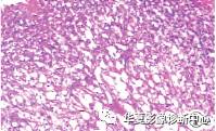 【病例】VHL综合征1例CT及MR 【病例】VHL综合征1例CT及MR