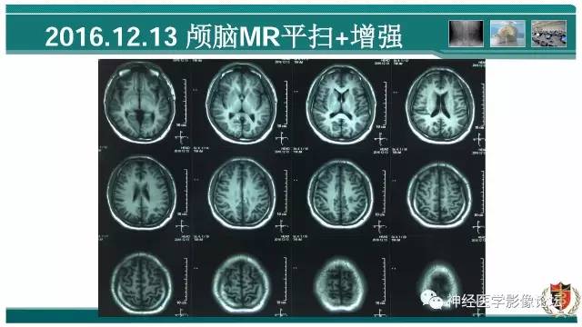 【病例】难得一见的IgG4脑炎MR