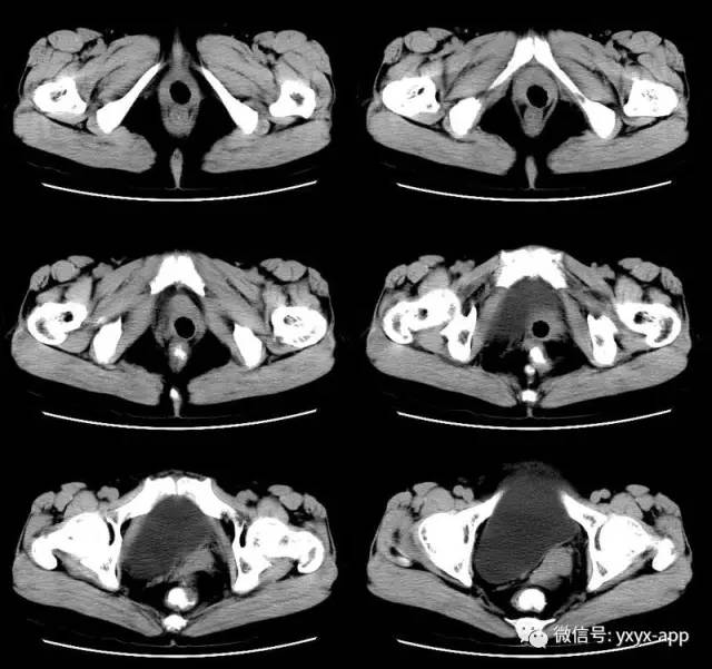 【病例】卵巢巨大单囊粘液性囊腺瘤1例CT 【病例】卵巢巨大单囊粘液性囊腺瘤1例CT