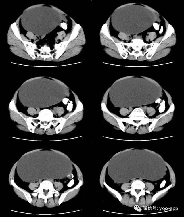 【病例】卵巢巨大单囊粘液性囊腺瘤1例CT 【病例】卵巢巨大单囊粘液性囊腺瘤1例CT