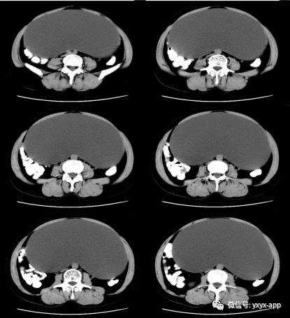 【病例】卵巢巨大单囊粘液性囊腺瘤1例CT