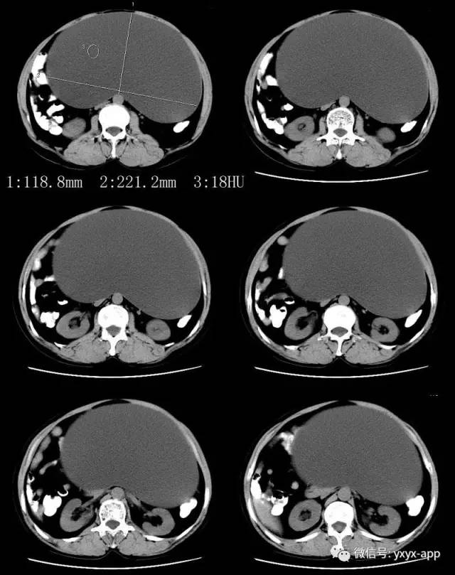 【病例】卵巢巨大单囊粘液性囊腺瘤1例CT 【病例】卵巢巨大单囊粘液性囊腺瘤1例CT