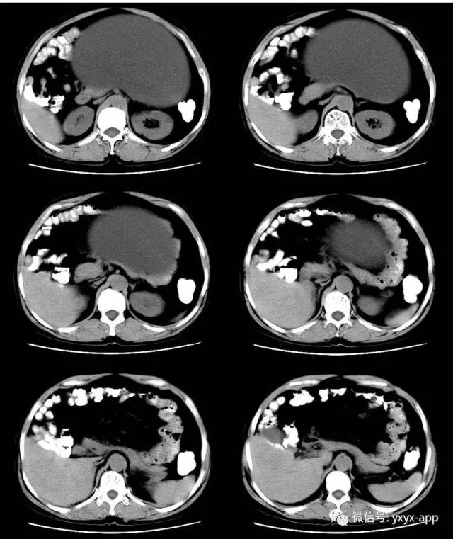 【病例】卵巢巨大单囊粘液性囊腺瘤1例CT 【病例】卵巢巨大单囊粘液性囊腺瘤1例CT