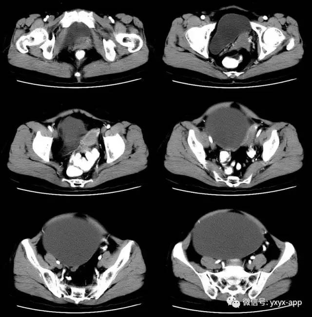 【病例】卵巢巨大单囊粘液性囊腺瘤1例CT 【病例】卵巢巨大单囊粘液性囊腺瘤1例CT
