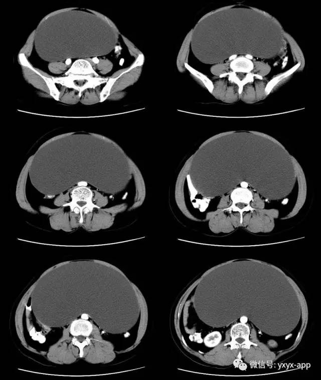 【病例】卵巢巨大单囊粘液性囊腺瘤1例CT 【病例】卵巢巨大单囊粘液性囊腺瘤1例CT